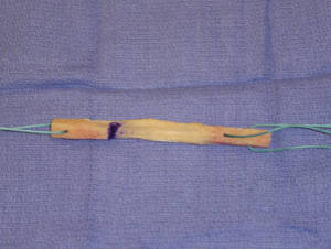 Bone-patellar tendon–bone (BPTB) ACL graft
