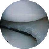 Partial meniscus repair